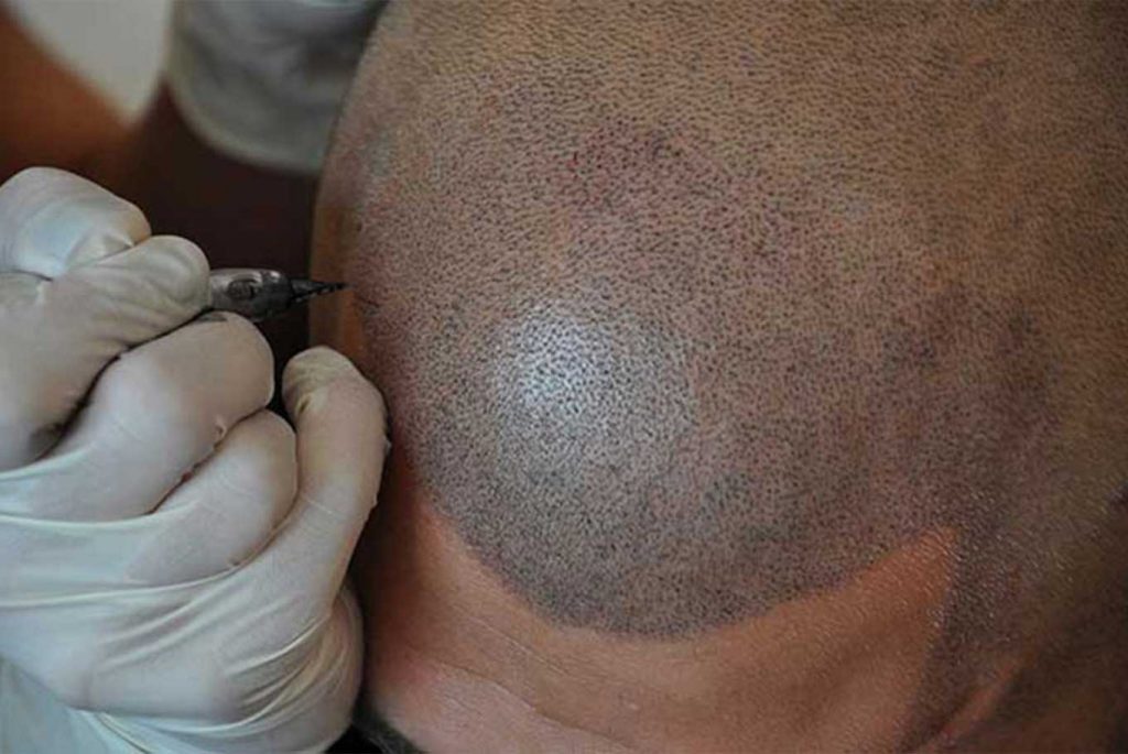 san antonio scalp micropigmentation